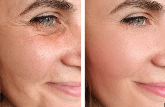 How Does Facelift Surgery Improve Facial Contours vs. Non-Surgical Alternatives?